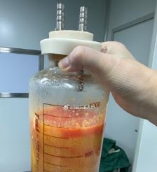 江阴水动力吸脂手术要做多久？